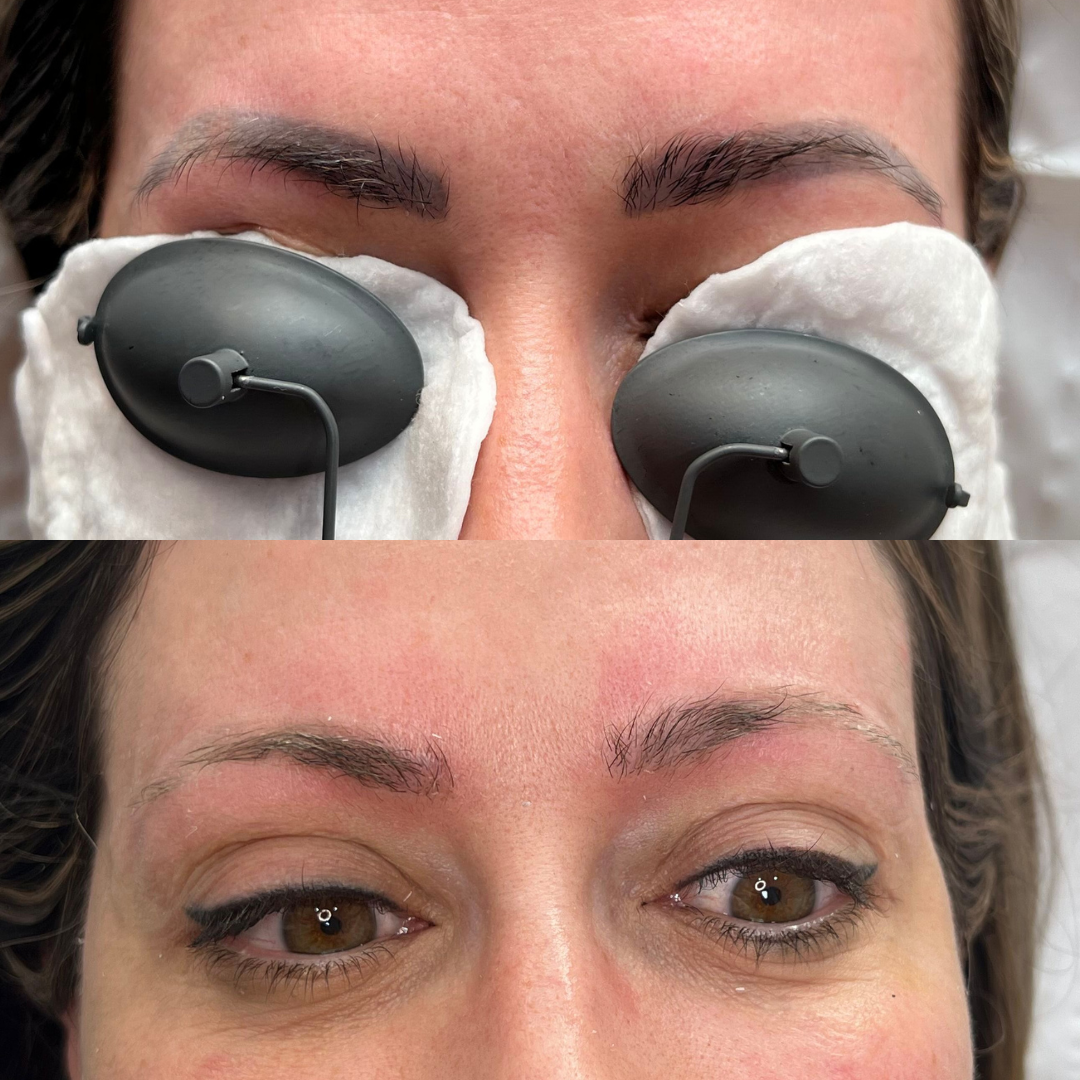 Before and after laser removal for microbladed brows